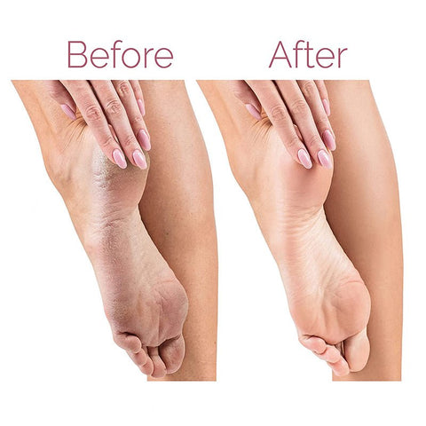 Callus Clear®
